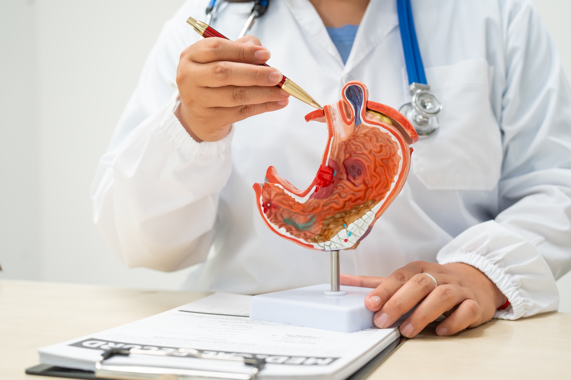 Doctor explicando los trastornos digestivos como úlceras de estómago y reflujo ácido.